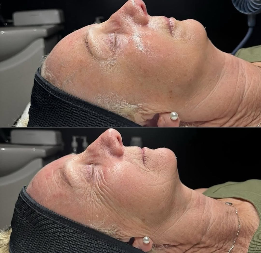 Tratamiento hidrafacial con V Tox Lifting Higher Power Mascarilla